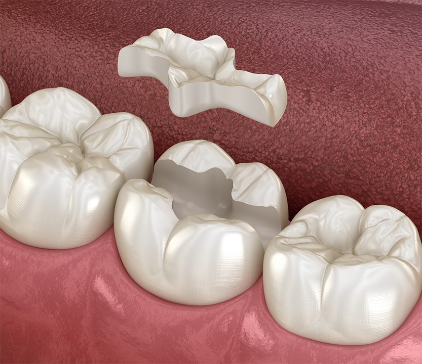 Illustration of inlay restoring a broken tooth