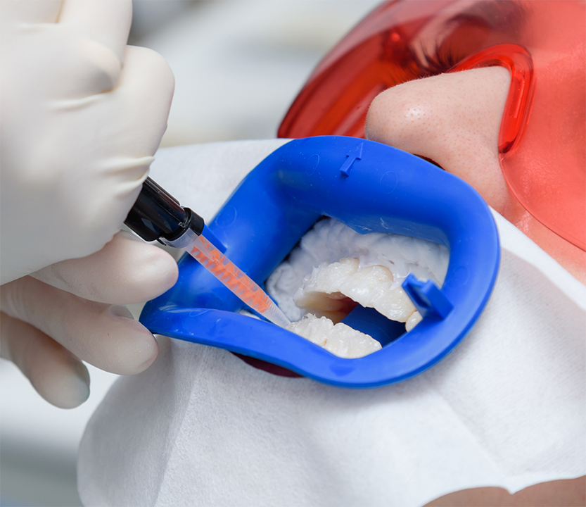 Dental patient having whitening gel applied to their teeth