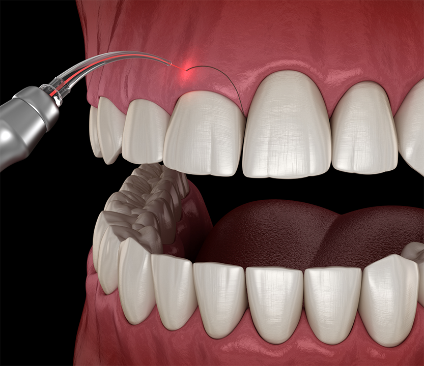 Illustration of a laser treating an uneven gumline