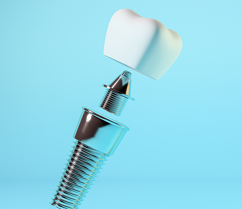 Model of a dental implant post, abutment, and crown