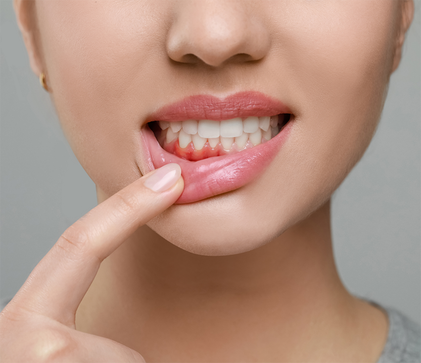 Woman pointing to her inflamed gums