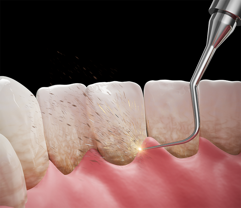 Illustration of dental instruments removing tartar buildup from the gums and teeth