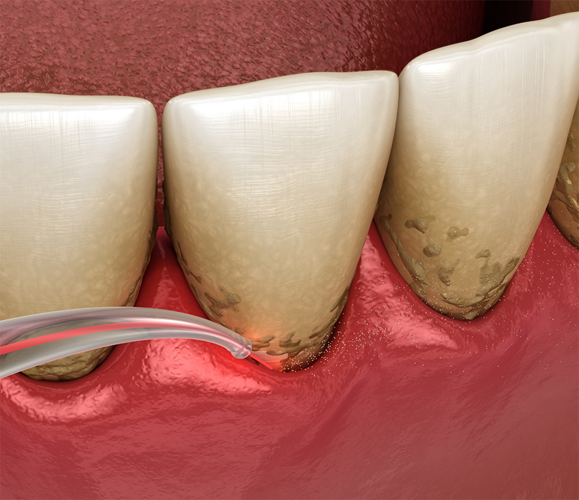 Illustration of a laser treating the gums