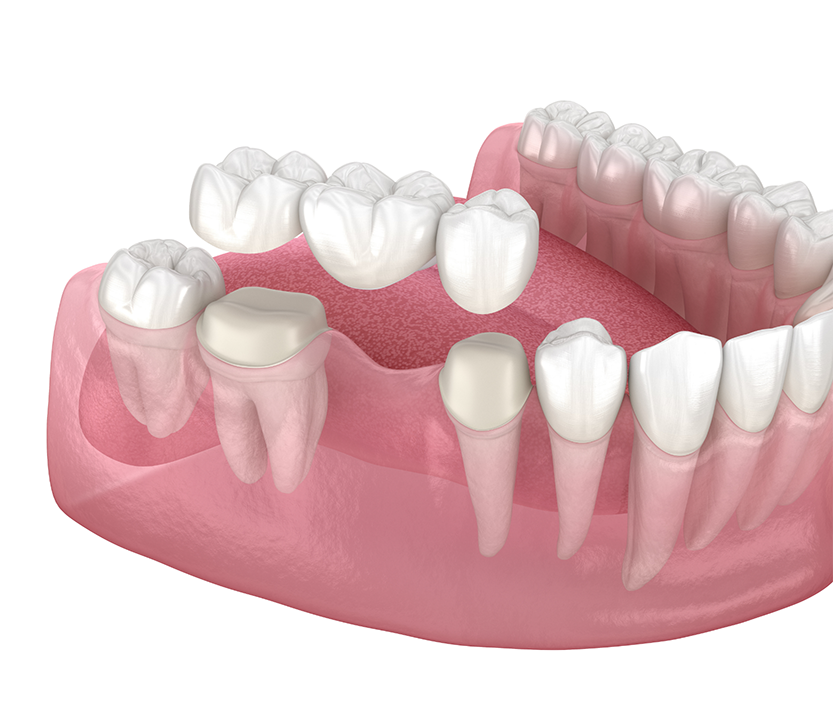 Illustration of a dental bridge being placed