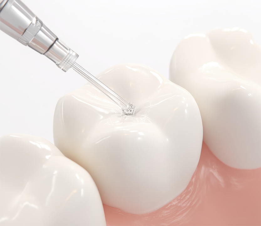 Model of a silver fluid being applied to a tooth