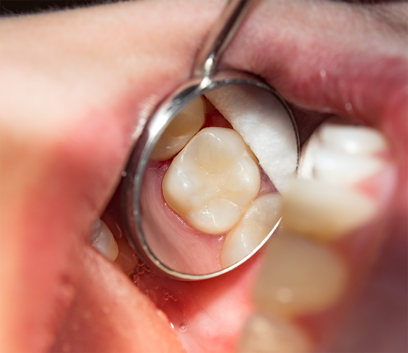 Dental mirror in a mouth