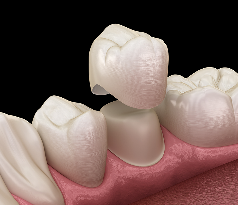 Illustration of a dental crown covering a tooth