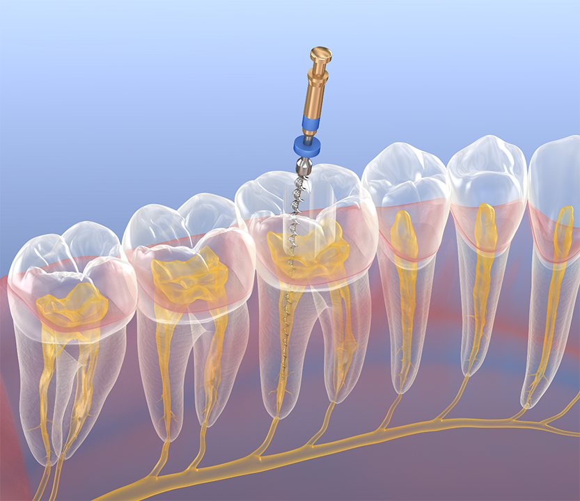Digital model of root canal treatment