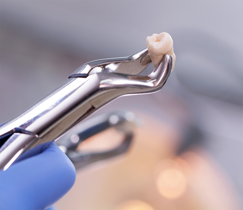 Forceps holding an extracted tooth